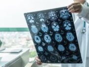 ASTUCE Spain reclama protocols específics per a aquesta patologia