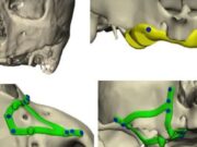 Els implants subperiòstics ressorgeixen gràcies a la planificació digital i la impressió 3D